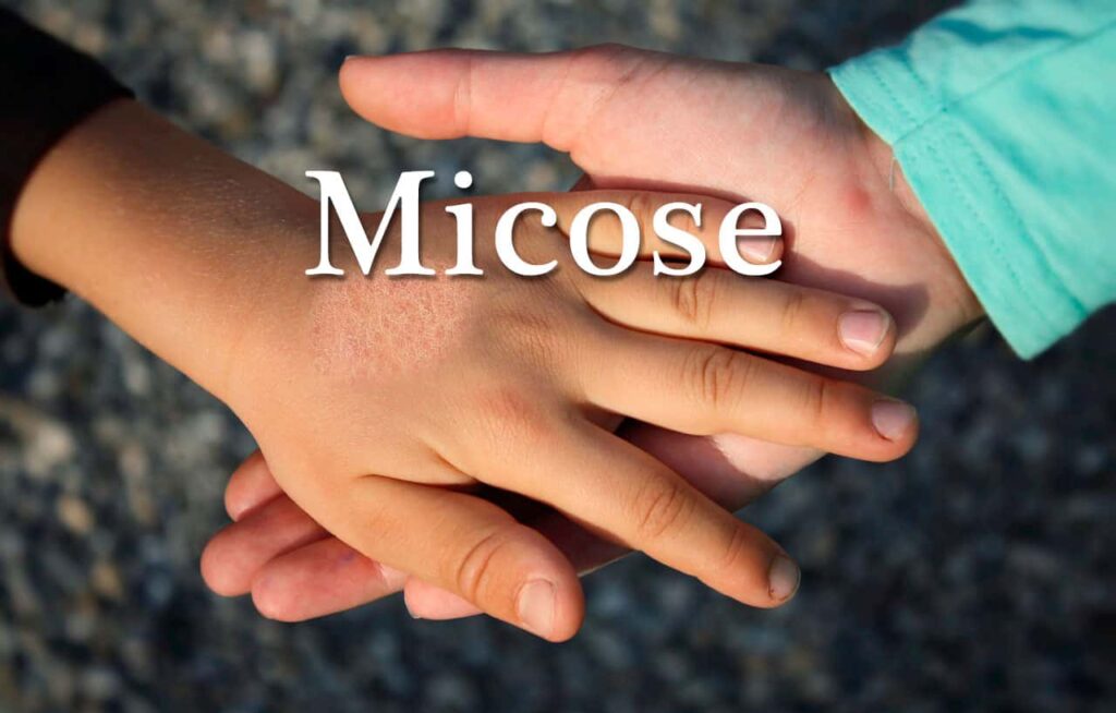 Micose - Definição, Tipos De Micoses, Causa, Como Evitar, Tratamento E ...